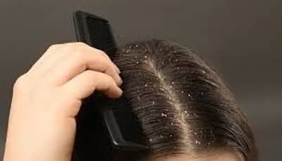 कोंड्यापासून मुक्ती हवीये ? त्वरित करा हे उपाय