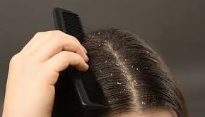 कोंड्यापासून मुक्ती हवीये ? त्वरित करा हे उपाय कोंड्यापासून मुक्ती हवीये ? त्वरित करा हे उपाय