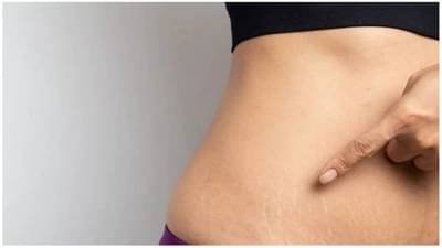 प्रसूतीनंतरचे स्ट्रेच मार्क्स कमी करण्यासाठी ट्राय करा हे घरगुती उपाय