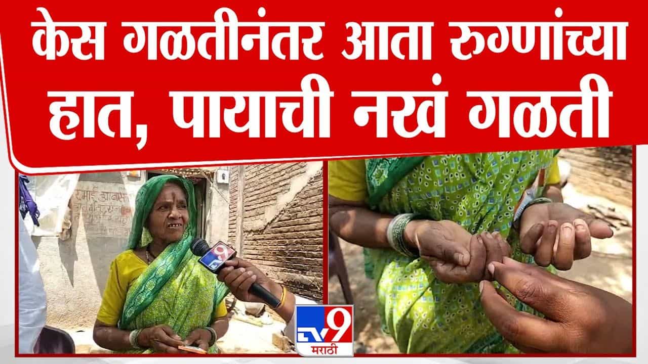 Buldhana News : केस गळतीनंतर आता नख गळती; बुलढण्यात चाललंय काय?