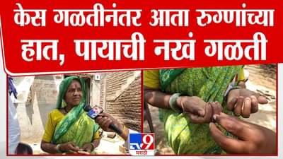 Buldhana News : केस गळतीनंतर आता नख गळती; बुलढण्यात चाललंय काय?
