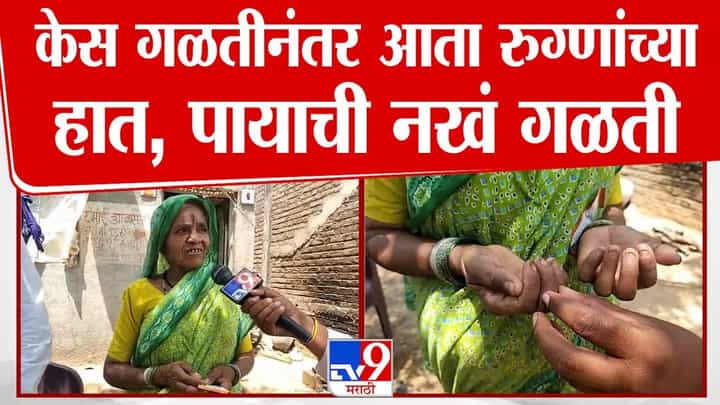Buldhana News : केस गळतीनंतर आता नख गळती; बुलढण्यात चाललंय काय? Buldhana News : केस गळतीनंतर आता नख गळती; बुलढण्यात चाललंय काय?