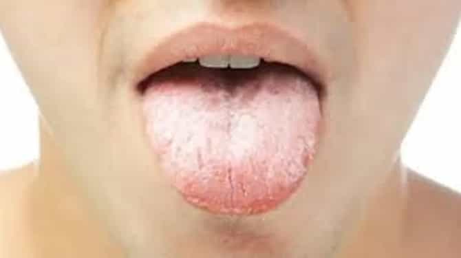 तुमचे तोंड वारंवार कोरडे पडतंय? होऊ शकतात हे 5 गंभीर आजारांची लक्षणे, जाणून घ्या