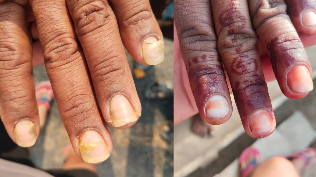 आता केस गळती झालेल्या रुग्णांची नखं अचानक विद्रूप झाली आहेत, तर काहींची नखं कमकुवत होऊ लागली आहेत. 
