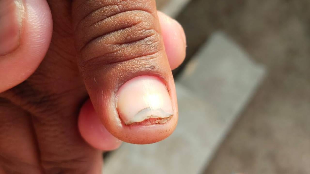 नखं गळतीमुळे परिसरातील नागरिकांमध्ये भीतीचं वातावरण निर्माण झालं आहे. 
