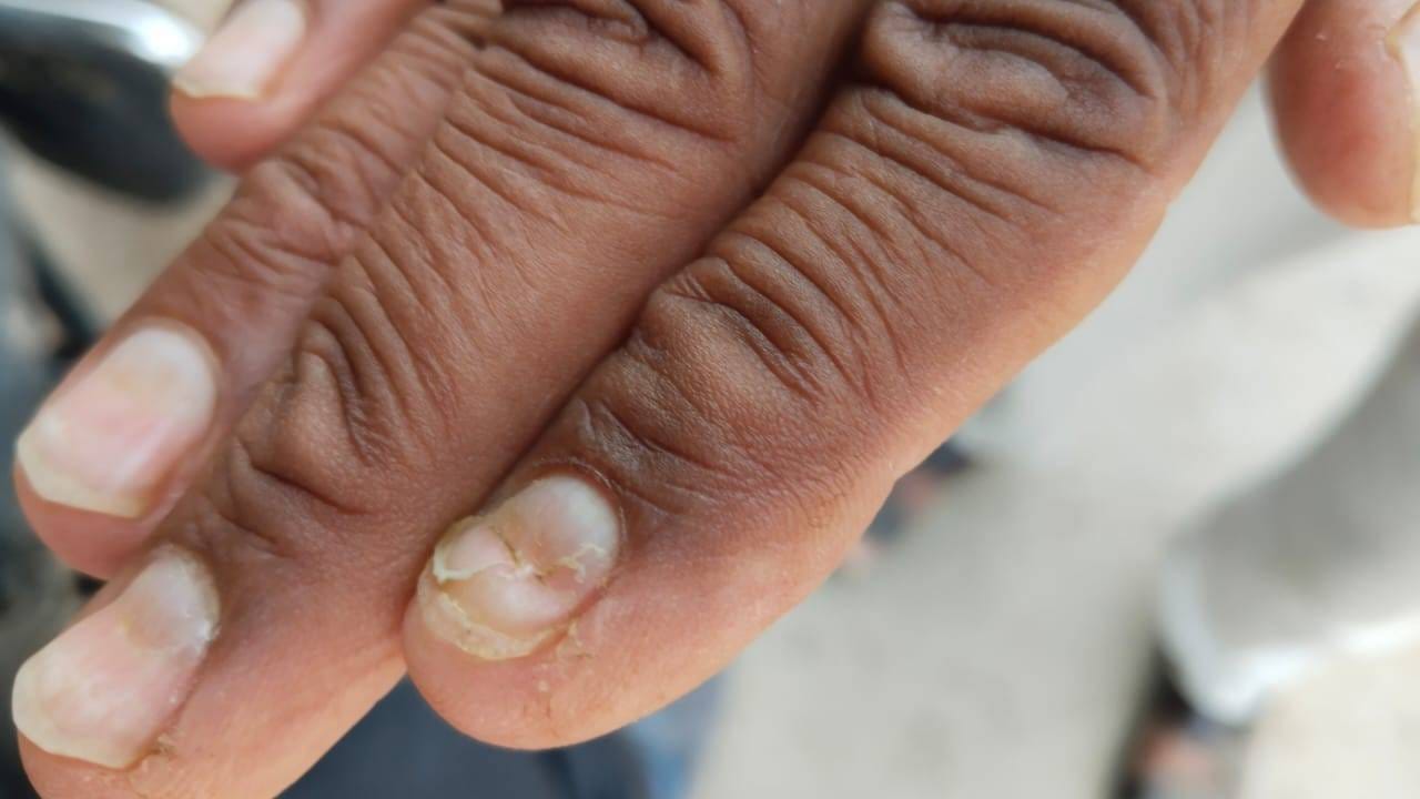 केस गळती झालेल्या रुग्णांची नखं कमकुवत होऊन विद्रूप झाली आहेत, तर काहींची नखं गळून पडत आहेत. 
