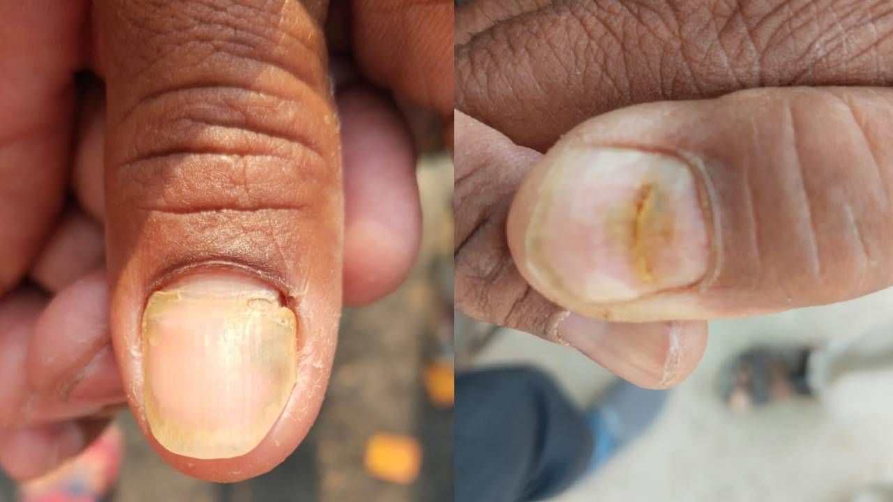 केस गळती झालेल्या रुग्णांची आता नखं गळती सुरू झाल्याची माहिती समोर येत आहे.
