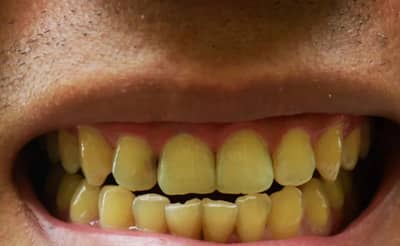रोज ब्रश करूनही माणसांचे दात पिवळे पडतात, मग प्राण्यांचे का नाही?