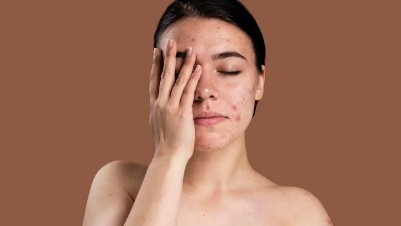 Pimple Problem: पिंपल्सच्या प्रॉब्लेममुळे त्रस्त आहात? 'या' सोप्या घरगुती टिप्स करा फॉलो Pimple Problem: पिंपल्सच्या प्रॉब्लेममुळे त्रस्त आहात? 'या' सोप्या घरगुती टिप्स करा फॉलो