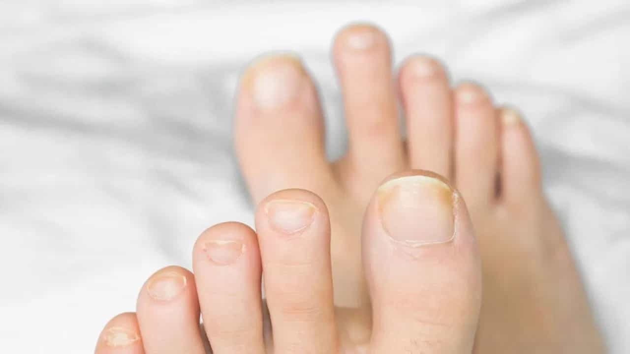 पावसाळ्यात पायांच्या नखांची योग्य काळजी घ्यायची असेल तर करा हे सोपे घरगुती उपाय