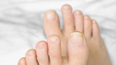 पावसाळ्यात पायांच्या नखांची योग्य काळजी घ्यायची असेल तर करा हे सोपे घरगुती उपाय
