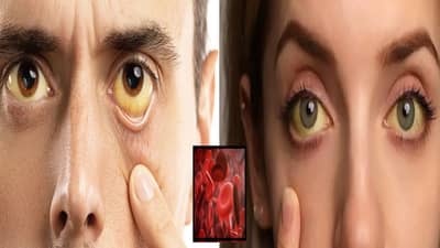 शरीरात कोणत्या व्हिटॅमिनच्या कमतरतेमुळे डोळे पिवळे होतात?