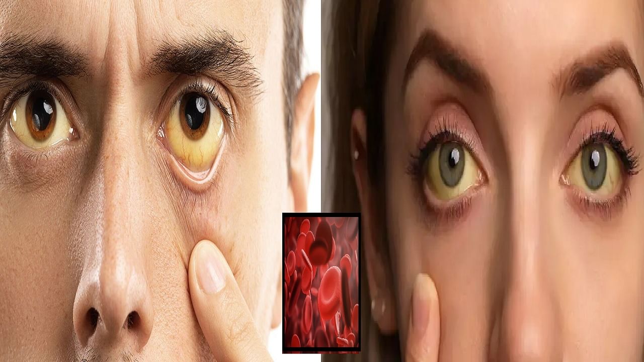 शरीरात कोणत्या व्हिटॅमिनच्या कमतरतेमुळे डोळे पिवळे होतात?