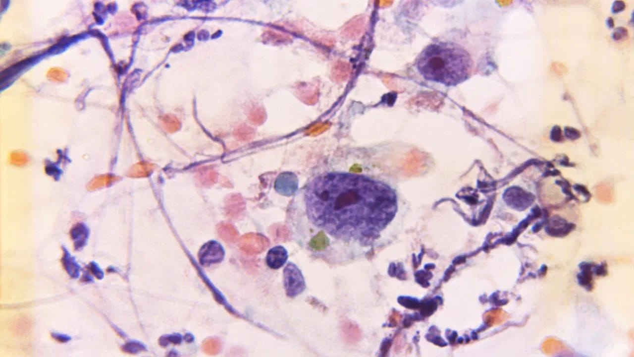 स्तनांची योग्य प्रकारे स्वच्छता न केल्यास संसर्गाचा धोका वाढतो. घाम आणि घाण साचल्याने बॅक्टेरिया निर्माण होऊ शकतात, ज्यामुळे त्वचेवर खाज सुटणे, जळजळ होणे आणि लालसरपणा येऊ शकतो.