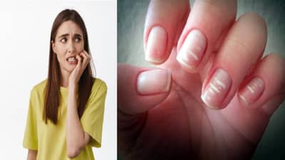 नखांवर पांढरे डाग का असतात? हे कोणत्या आजाराचे लक्षण आहे?