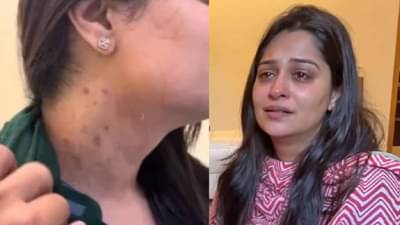 लिव्हर कॅन्सर सर्जरीनंतर दीपिकाची अशी अवस्था; मानेवरच्या खुणा पाहून नेटकरी चिंतेत