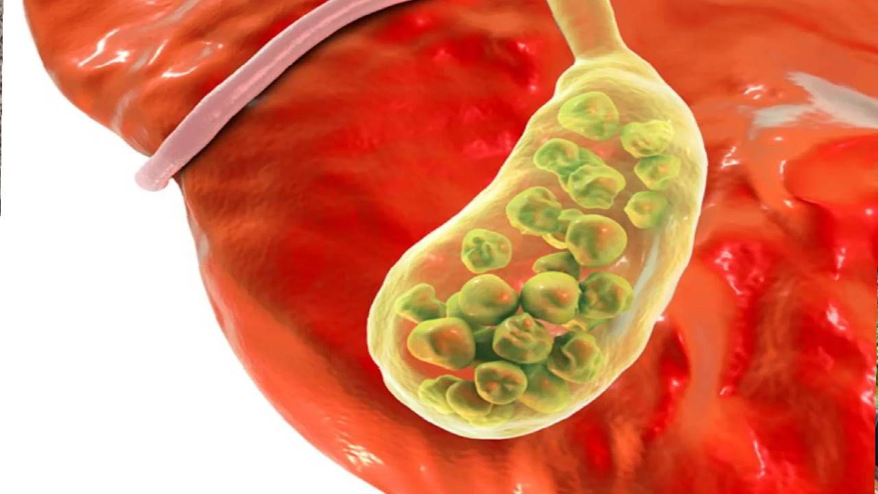 पित्ताचे दगड म्हणजे काय? ‘या’ 4 सवयी तुमच्या पित्ताशयातील दगडांना कारणीभूत, जाणून घ्या