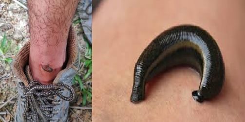 Leech Bites