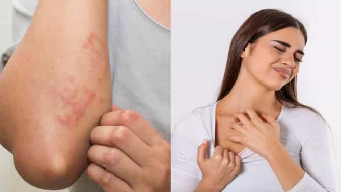 पावसाळ्यात फंगल इंफेक्शन होऊ नये यासाठी स्वत:चे करा असे संरक्षण