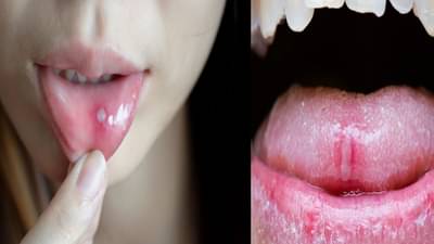 सारखं तोंड येणे किंवा तोंडात जखम होणे सामान्य की माऊथ कॅन्सरची लक्षणे? कसं ओळखावं?