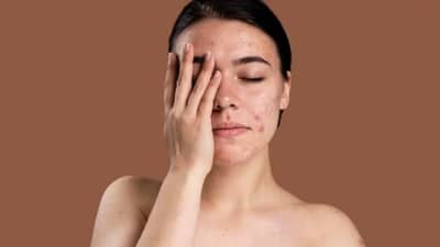 Skincare Tips: पिंपल्स फ्री त्वचेसाठी योग्य पद्धतीनं स्किनकेअर कसा करावा? जाणून घ्या