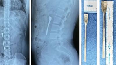 तरुणाने गिळला चमचा, 8 सेंटीमीटरची ही वस्तू घशात अडकल्याने इमर्जन्सी ऑपरेशन केले, अन् असे वाचवले प्राण