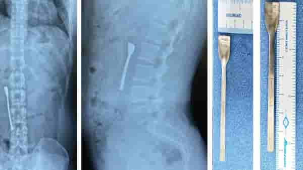 तरुणाने गिळला चमचा, 8 सेंटीमीटरची ही वस्तू घशात अडकल्याने इमर्जन्सी ऑपरेशन केले, अन् असे वाचवले प्राण