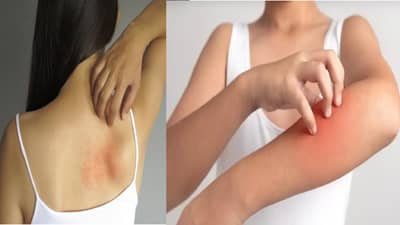 पावसाळ्यात त्वचेला खाज येण्याची समस्या अधिक वाढते? तर करू नका या चुका