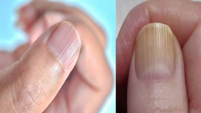 नखांवर हलक्या रेषा येणे कोणत्या आजाराचे संकेत? आताच व्हा सावधान
