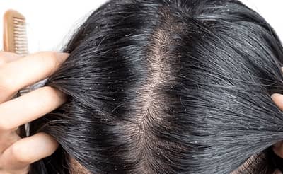 पावसाळ्यात केसांमधील कोंड्यामुळे त्रस्त आहात? हे घरगुती टॉनिक नक्की करा ट्राय....