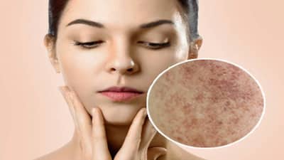 पिंपल्समुळे चेहऱ्यावरील काळे डाग जात नाहीये? तर या 5 नैसर्गिक फेसपॅकच्या मदतीने ही समस्या करा दूर