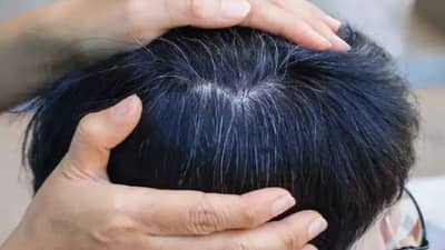 कमी वयात केस पांढरे होत आहेत? असू शकते या गोष्टींची कमतरता, काय उपाय करावेत?