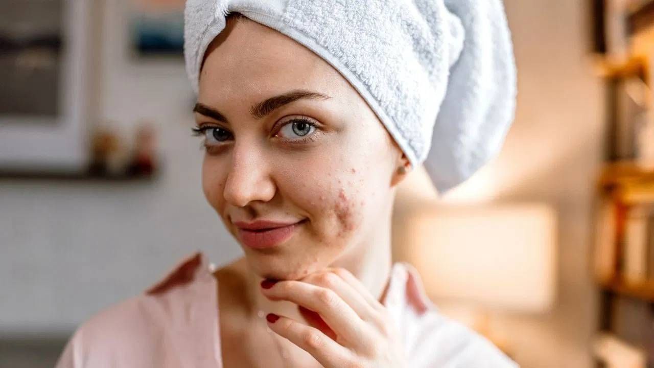 आठवड्यातून दोनदा लावा 'हा' अँटीबॅक्टेरियल फेस पॅक, पावसाळ्यात पिंपल्स होतील छू मंतर..