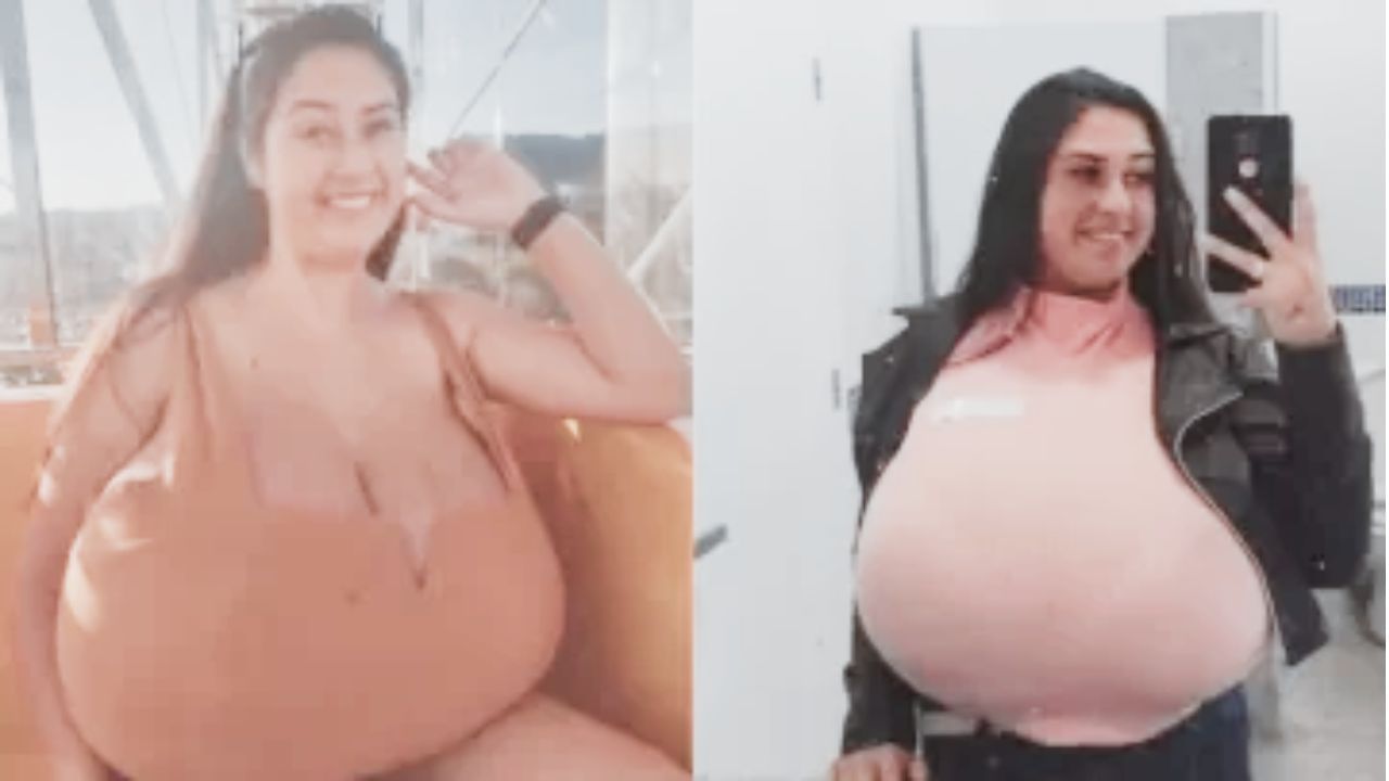 थायनारा मार्कोंडेस असे या मुलीचे नाव असून ही ब्राझीलमधील २२ वर्षीय तरुणी आहे. धक्कादायक बाब म्हणजे काही महिन्यांत स्तनांचा आकार १२ किलोपर्यंत वाढला.