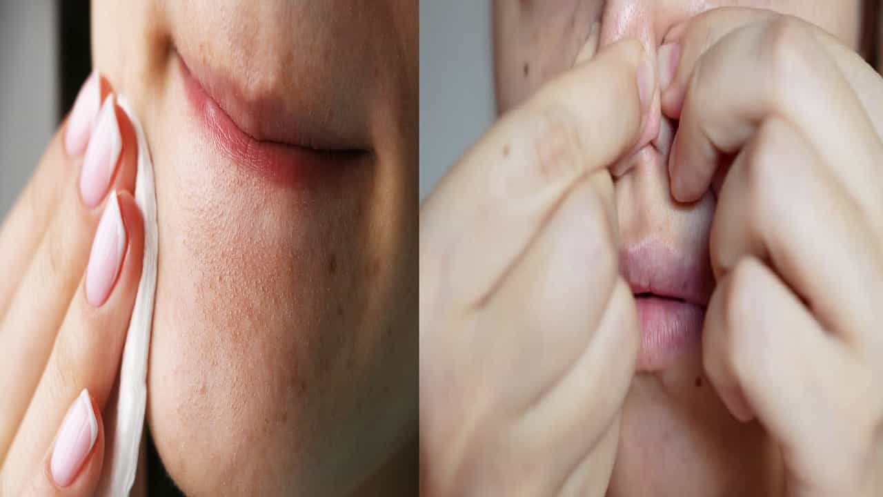 ना स्ट्रिप्सची गरज, ना पार्लरचा खर्च! ब्लॅकहेड्स काढण्यासाठी या 4 टिप्सचा करा वापर