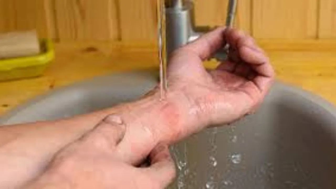 अशा परिस्थितीत, तुम्ही ताबडतोब काही घरगुती उपायांचा अवलंब करावा. जर तुम्हाला जास्त फोड आले किंवा त्वचेचा आतील थर देखील जळाला असेल तर तुम्ही ताबडतोब डॉक्टरांशी संपर्क साधावा.