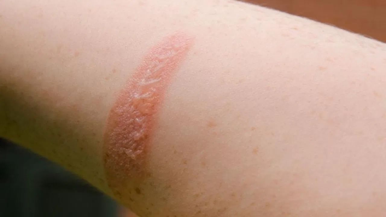 भाजल्यास प्रथम काय करावे?: डॉक्टरांनी सांगितले की जर तुमचा हात किंवा शरीराचा कोणताही भाग भाजला असेल तर प्रथम तो थंड पाण्याने स्वच्छ करा. जर तुम्ही जास्त भाजला नसाल तर प्रथमोपचार फायदेशीर ठरेल. 