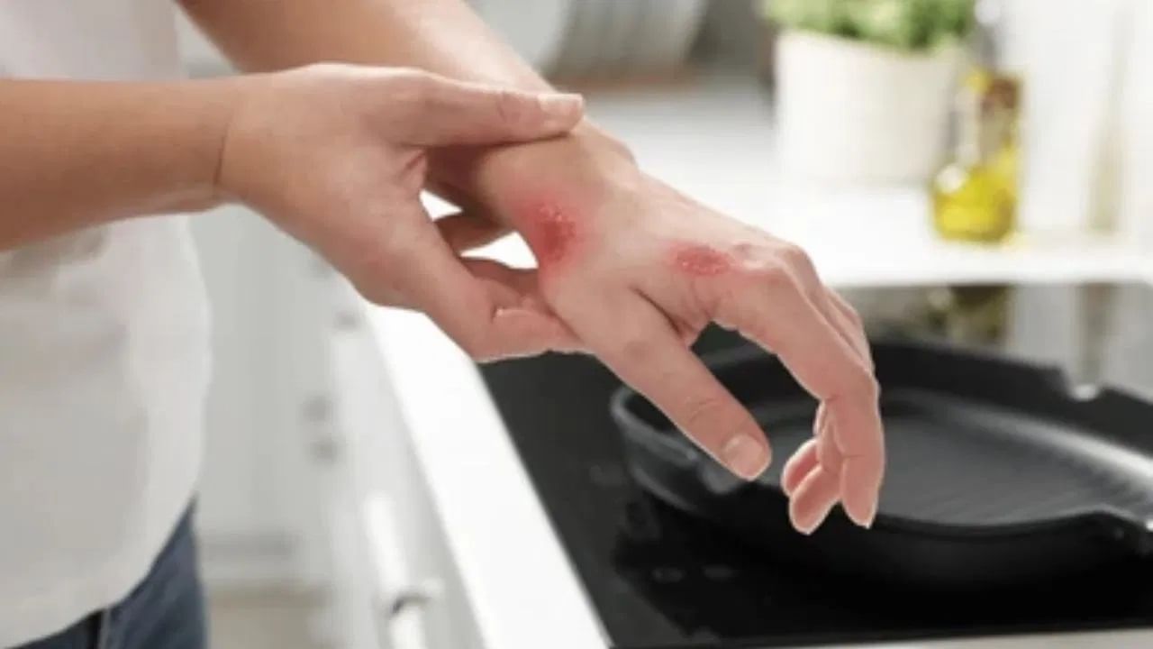 सोफ्रामायसिन, लिग्नोकेन आणि सल्फासॅलाझिनची एक ट्यूब मिसळा आणि ती प्रभावित भागात लावा. जर तुम्हाला हे लगेच मिळत नसेल तर तुम्ही टूथपेस्ट देखील लावू शकता. जर भाजणे गंभीर असेल तर ताबडतोब डॉक्टरांशी संपर्क साधा.