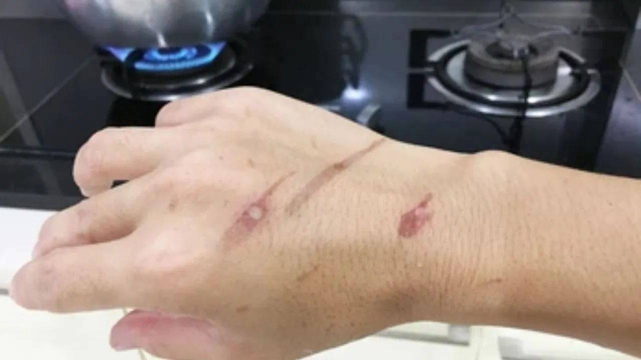 जळल्यानंतर फोड येऊ नयेत म्हणून तुम्ही केळीचा गर, नारळाचे तेल किंवा बटाट्याचा रस लावू शकता. यामुळे सूज कमी होण्यास देखील मदत होईल.