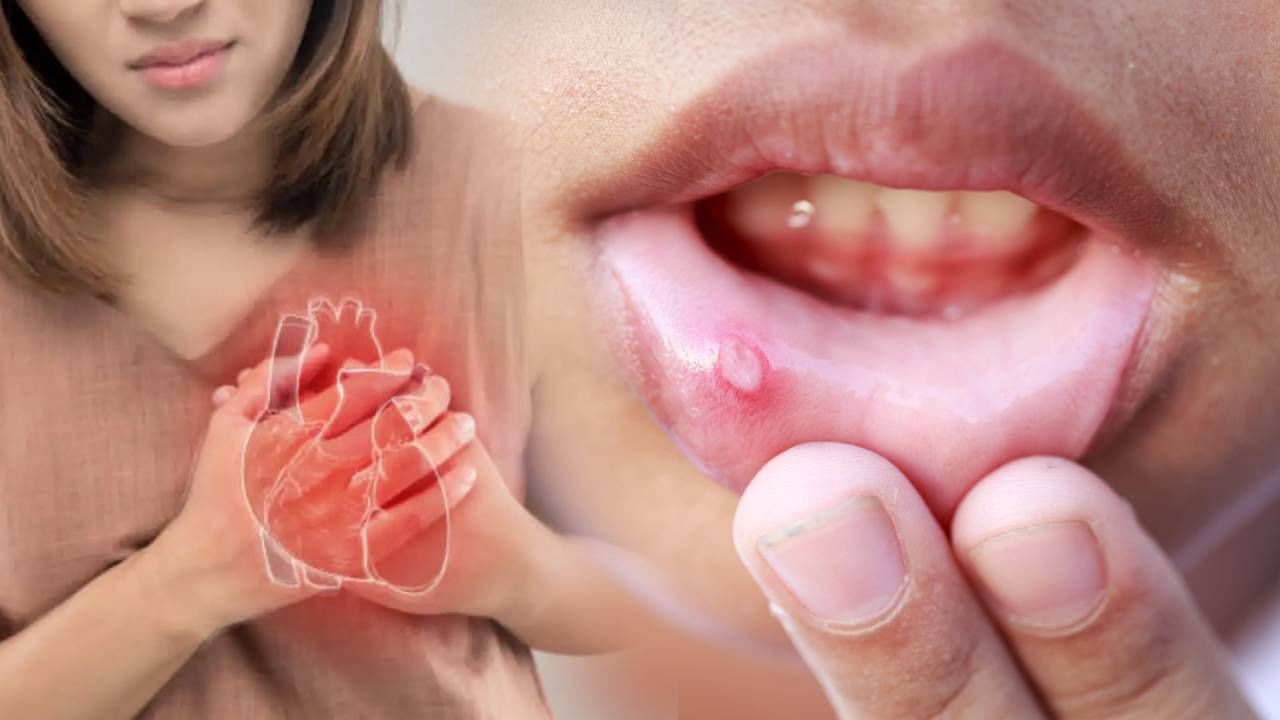 पोटाच्या समस्यांमुळे तोंडात अल्सर होतात असं म्हटलं जातं, पण कधीकधी हे अल्सर हृदयविकाराच्या झटक्याचं लक्षण असू शकतात. डॉक्टरांच्या मते, तोंडात अल्सरची समस्या हृदयविकाराच्या आधी उद्भवू शकते. त्यामुळे तोंडात अल्सर होत असल्यास त्याकडे दुर्लक्ष करू नका. 