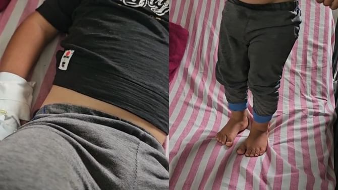 एकाच कुटुंबातील तीन मुलांना अचानक लुळेपणा... अचानक उद्भवलेल्या आजाराने एकाच कुटुंबातील तीन मुलांना अचानक लुळेपणा... अचानक उद्भवलेल्या आजाराने