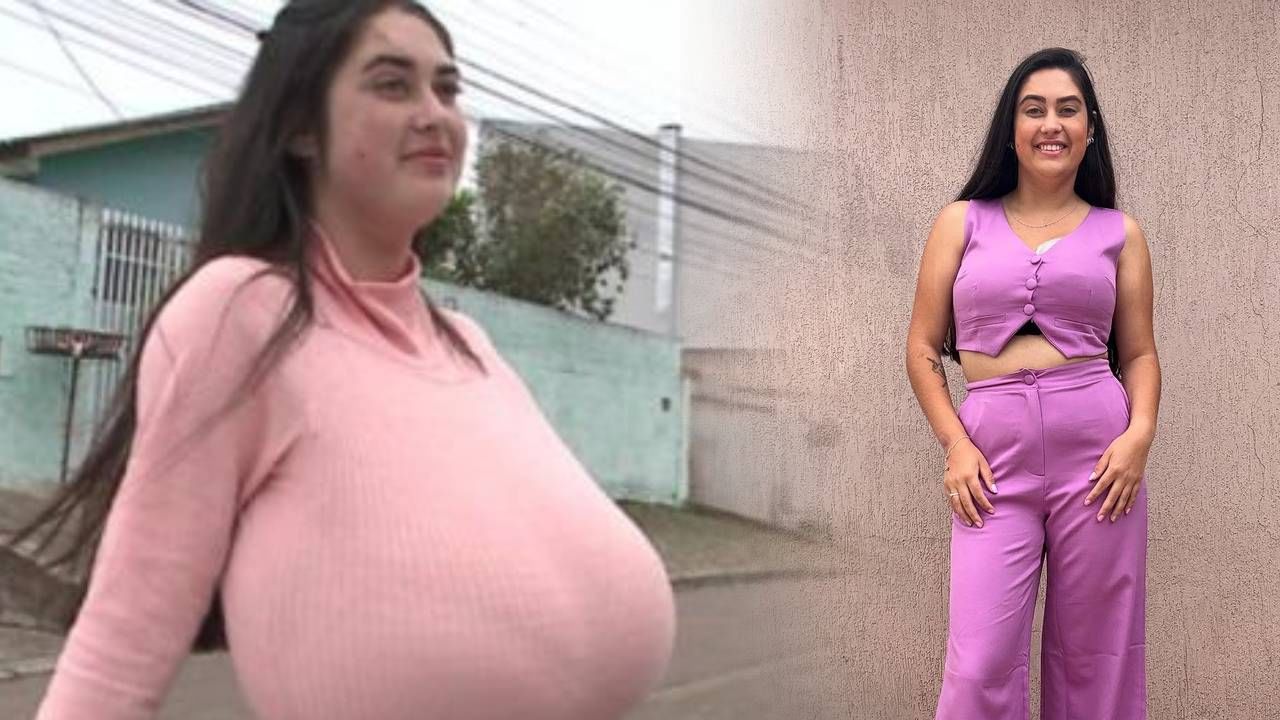 यानंतर तरुणीला सर्जरीद्वारे आकार कमी करावा लागला. तिच्यावर १० तासांची सर्जरी करण्यात आली. या सर्जरीमध्ये तिच्या स्तनातून २२ पौंड (सुमारे १० किलो) अतिरिक्त टिश्यू काढून टाकण्यात आला. 