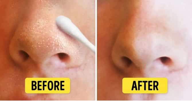 आपल्या चेहऱ्यावर व्हाईटहेड्स का येतात? ते कमी करण्यासाठी या टिप्स करा फॉलो