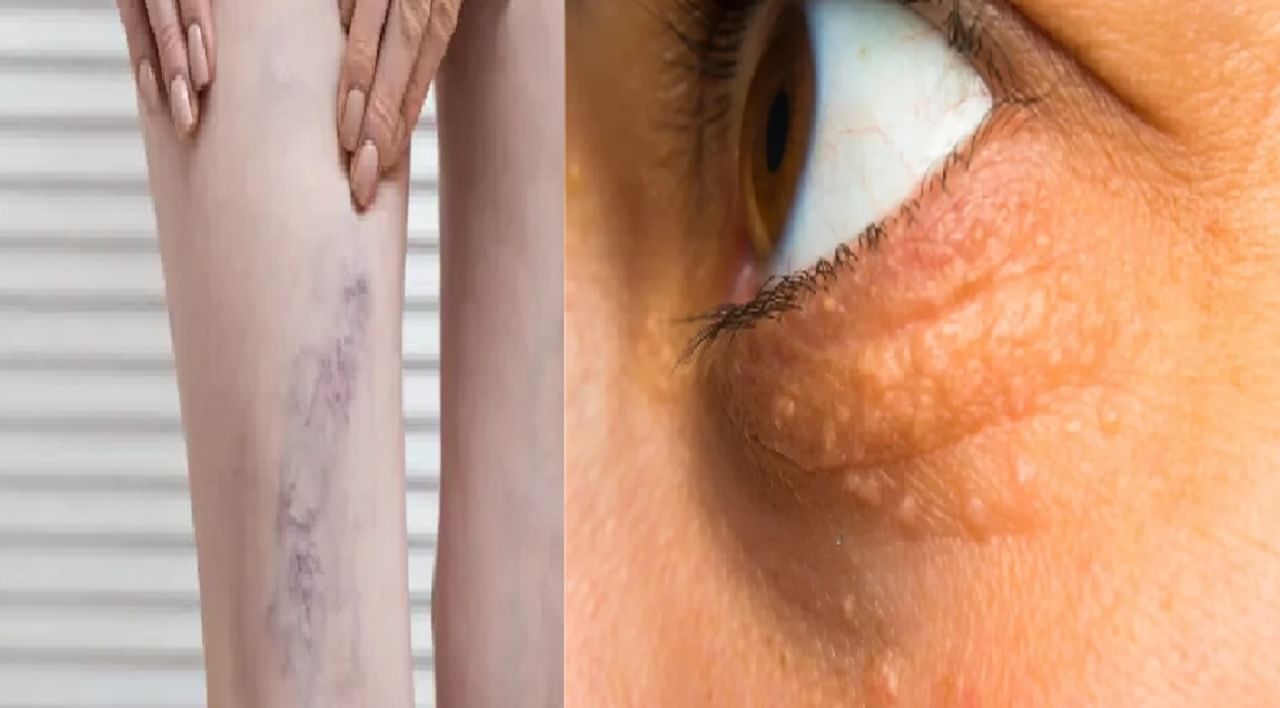 त्वचेवर दिसणारी ही 5 लक्षणे दर्शवतात की तुमचं कोलेस्ट्रॉल वाढलं आहे; तुम्हाला पण जाणवतायत का ही लक्षणे? त्वचेवर दिसणारी ही 5 लक्षणे दर्शवतात की तुमचं कोलेस्ट्रॉल वाढलं आहे; तुम्हाला पण जाणवतायत का ही लक्षणे?