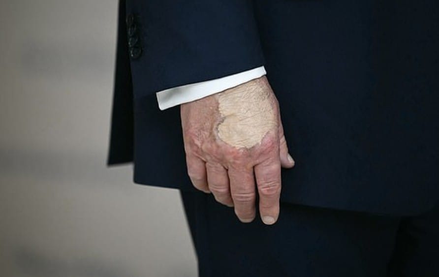 दरम्यान, ट्रम्प यांचे काही अजब फोटो समोर आले असून ट्रम्प यांना पाठिंबा देणाऱ्यांची चिंता वाढली आहे. हे फोटो सध्या सोशल मीडियावर चांगलेच व्हायरल होत आहेत. या फोटोंमध्ये त्यांच्या हातावर एक डाग दिसत आहे. 