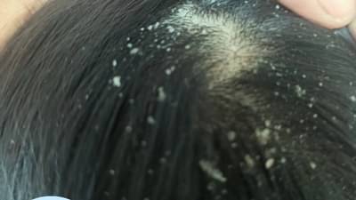 कोंड्यापासून मुक्ती मिळवण्यासाठी या चुका त्वरीत टाळा....