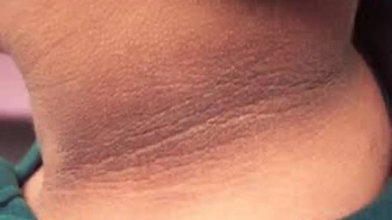 मानेवरील काळपटपणा छुमंतर; तुरटीचा करा असा वापर