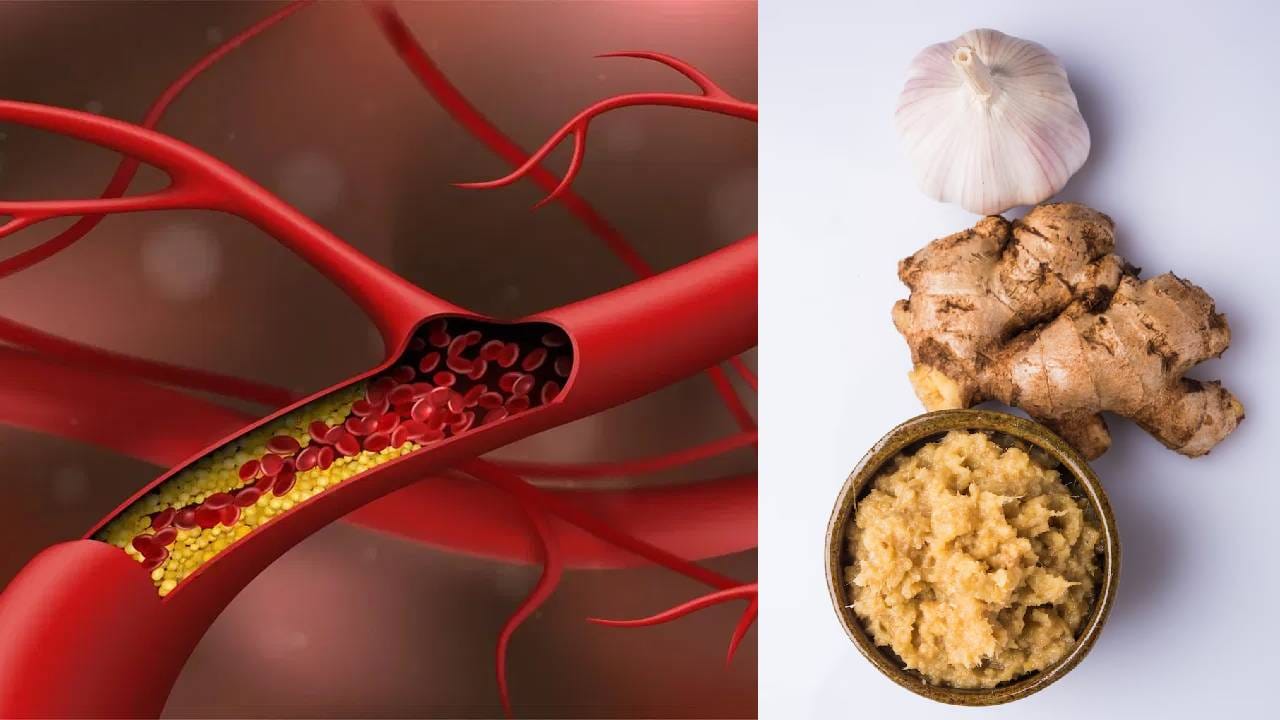 जर तुम्हाला उच्च कोलेस्ट्रॉल असेल, तर तुमच्या रक्तवाहिन्यांमध्ये चरबी जमा होऊ शकते. कालांतराने ही जमा चरबी तुमच्या धमन्यांमधून वाहणाऱ्या रक्ताचे प्रमाण घट्ट आणि मर्यादित करते. कधीकधी ही जमा चरबी अचानक वाढू शकते आणि गुठळी तयार करू शकते, ज्यामुळे हृदयविकाराचा झटका किंवा स्ट्रोक होऊ शकतो. लसूण आणि आल्यामध्ये आढळणारे शक्तिशाली अँटी-इन्फ्लेमेटरी गुणधर्म आणि अँटिऑक्सिडंट्स दीर्घकाळ चालणाऱ्या जळजळीशी संबंधित प्रो-इन्फ्लेमेशन प्रोटीनला अडवण्यास मदत करू शकतात.