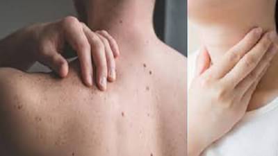 कॅन्सरची सामान्य लक्षणे जी लोक सहसा दुर्लक्ष करतात, जाणून घ्या अन्यथा परिणाम गंभीर होऊ शकतात