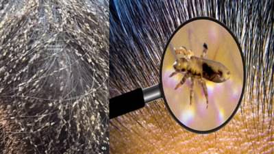 आता लहान मुलांच्या डोक्यातील उवांचा करा कायमचा बंदोबस्त, फक्त 15 मिनिटांत होतील गायब
